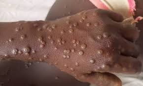 Mpox : Un nouveau cas confirmé à Dakar